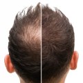 Lifestyle Factors and Male Pattern Baldness: Understanding the Causes and Solutions