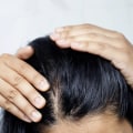 Menopause and Hair Loss: Understanding the Causes and Treatments