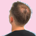 Understanding Male Pattern Baldness: Causes, Treatments, and Prevention