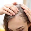 Understanding Female Hair Loss: Causes, Prevention, and Treatment