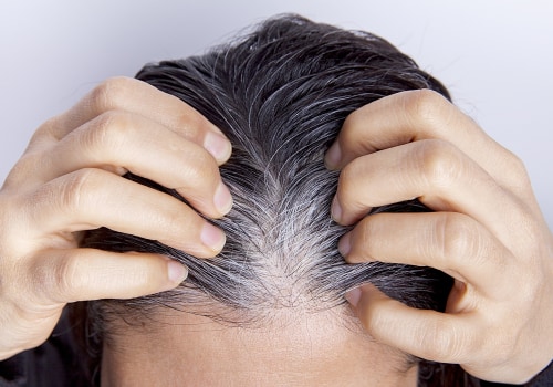 Female Pattern Hair Loss: Understanding Causes, Prevention, and Treatment
