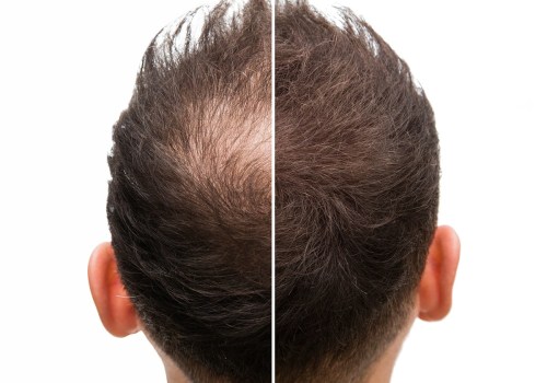Lifestyle Factors and Male Pattern Baldness: Understanding the Causes and Solutions