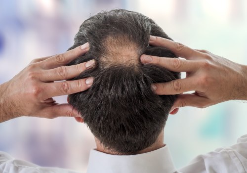 Understanding Finasteride: A Comprehensive Guide to Preventing Baldness and Promoting Hair Growth