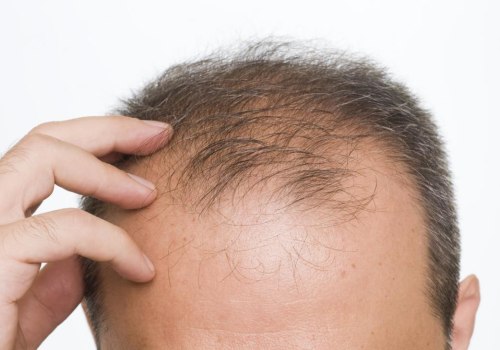 Understanding Minoxidil for Hair Loss: A Comprehensive Guide