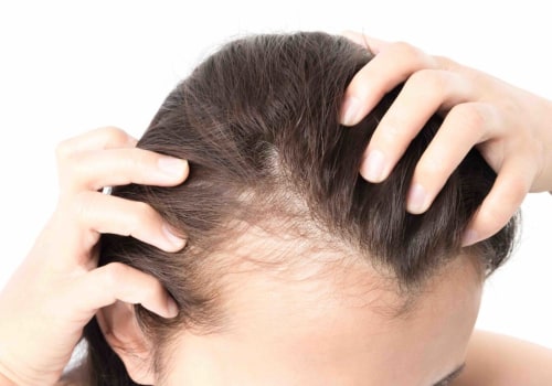 Understanding Hormonal Imbalances and Hair Loss
