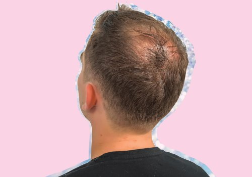 Understanding Male Pattern Baldness: Causes, Treatments, and Prevention