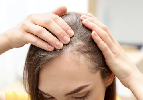 Understanding Female Hair Loss: Causes, Prevention, and Treatment