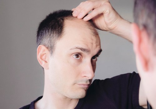 Lifestyle Changes for Preventing Male Pattern Baldness: Everything You Need to Know