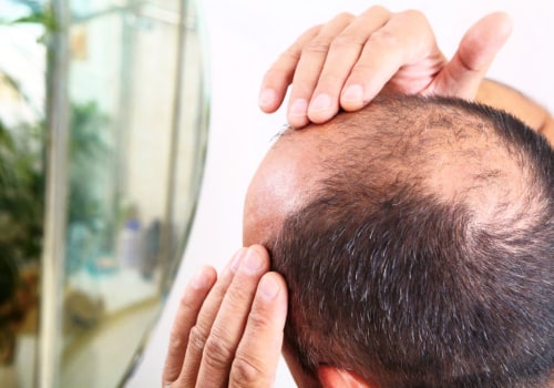 Medical treatments for male pattern baldness: What You Need to Know